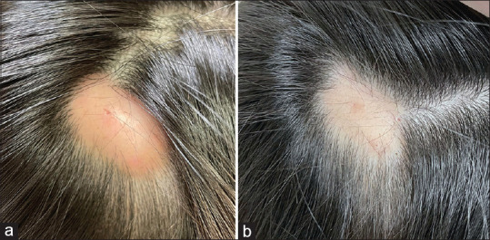 Alopecic Scalp Cysts Following Isotretinoin.