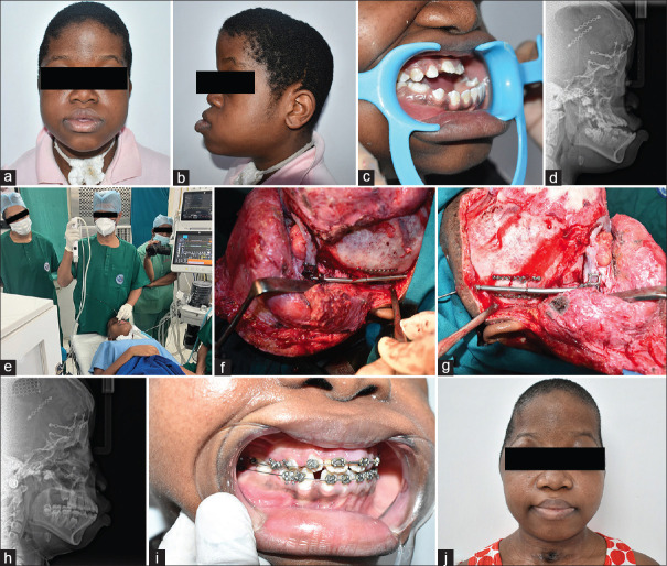 Decannulation Dilemmas - Timing Tracheostomy Tube Removal in Children with Craniofacial Deformities - A Retrospective Study.