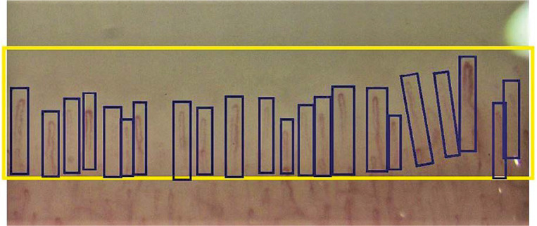 Automatic assessment of nailfold capillaroscopy software: a pilot study.