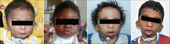 Decannulation Dilemmas - Timing Tracheostomy Tube Removal in Children with Craniofacial Deformities - A Retrospective Study.