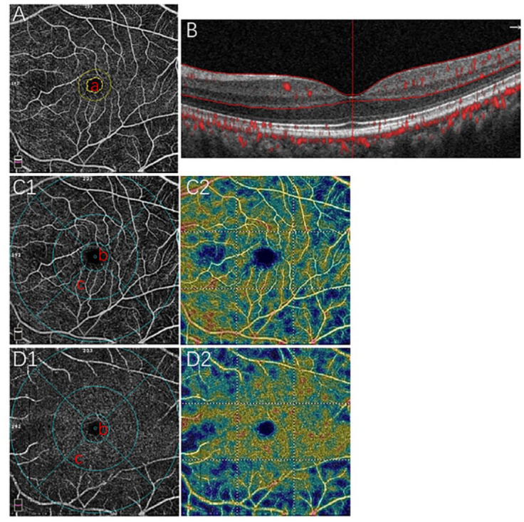Evaluation of early retinal changes in patients on long-term hydroxychloroquine using optical coherence tomography angiography.
