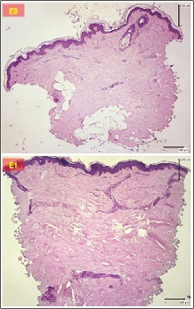 Evaluation of Wrinkle and Dermal Thickness in the Forearm before and after Picosecond Laser Therapy.