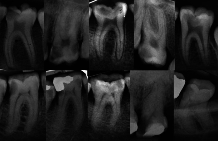Comparative Outcomes of Pulpotomy in Mature Molars with Irreversible Pulpitis: A Non-Randomized Trial Evaluating Calcified and Non-Calcified Pulp Chambers.
