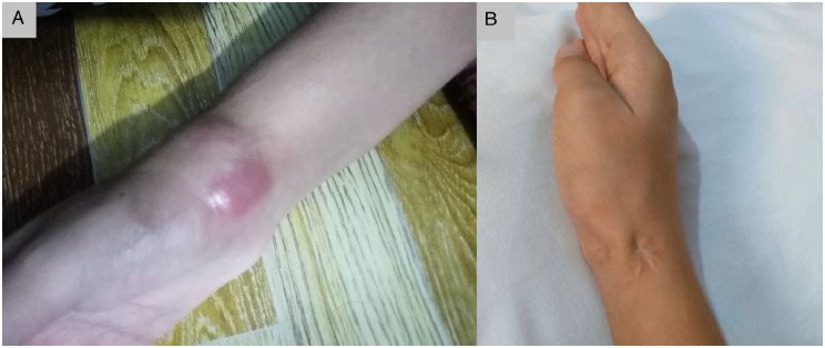 An Impressive Response to Zoldronic Acid Treatment for Chronic Recurrent Multifocal Osteomyelitis: A Case Report.