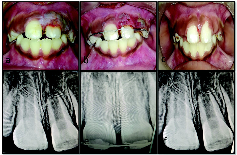 Management of Laryngoscope-Induced Iatrogenic Dental Injury: A Case Series.