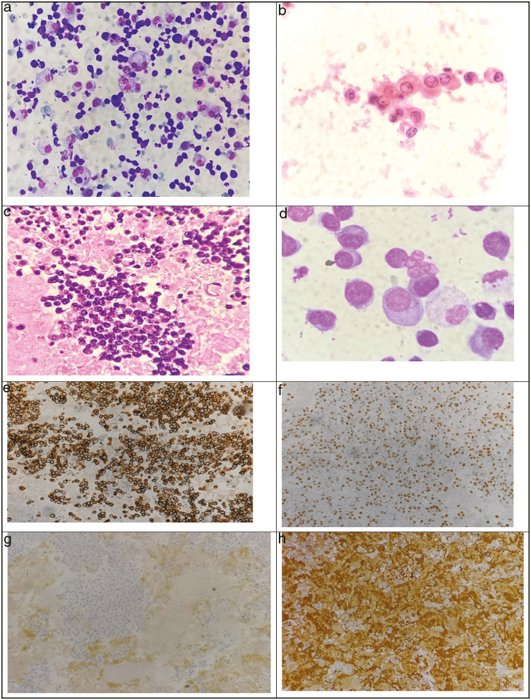 Plasma Cells Out for a Swim! A Study on Myelomatous Involvement of Effusion Fluid and Cerebrospinal Fluid: A 10-Year Experience from a Tertiary Cancer Center.