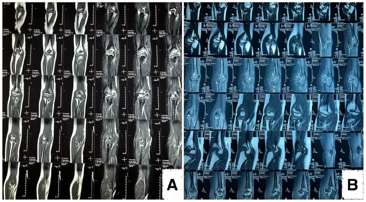 An Impressive Response to Zoldronic Acid Treatment for Chronic Recurrent Multifocal Osteomyelitis: A Case Report.