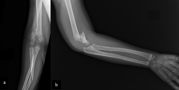 Pediatric Floating Elbow: Case Report and Review of the Literature.