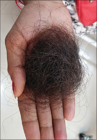 Hair Root Dermoscopy from Shed Hair: A Simple Diagnostic Tool in Telogen Effluvium.
