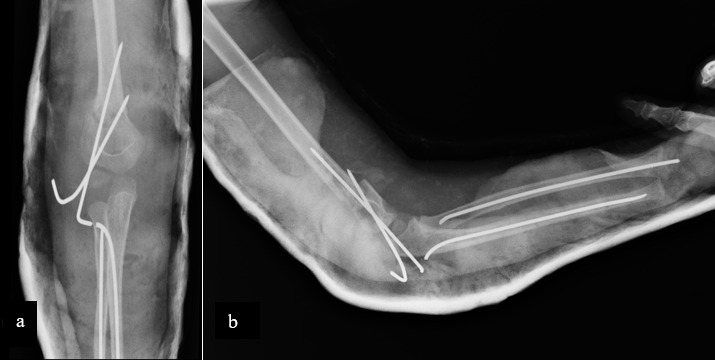 Pediatric Floating Elbow: Case Report and Review of the Literature.