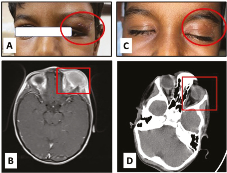 FNAC Diagnosis Giant Cell Reparative Granuloma of the Orbit Masquerading as Malignancy.