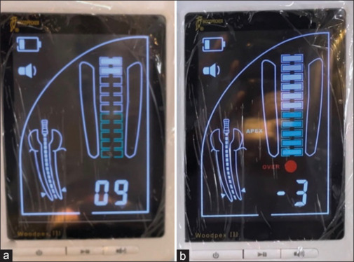 A novel technique to detect cover screw location at stage two uncovery surgery over conventional technique - A randomized controlled trial.