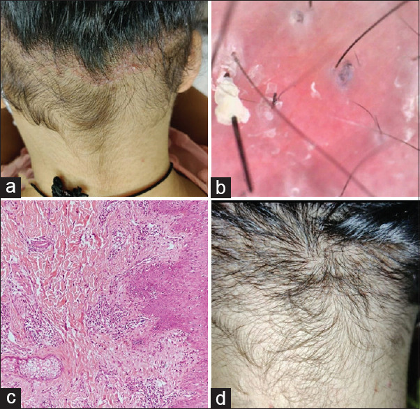 Traction Folliculitis: An Unrecognized Entity.