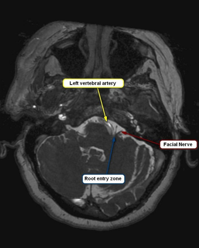 Treatment Challenges in Hemifacial Spasm: The Role of Magnetic Resonance Imaging.