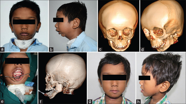 Decannulation Dilemmas - Timing Tracheostomy Tube Removal in Children with Craniofacial Deformities - A Retrospective Study.