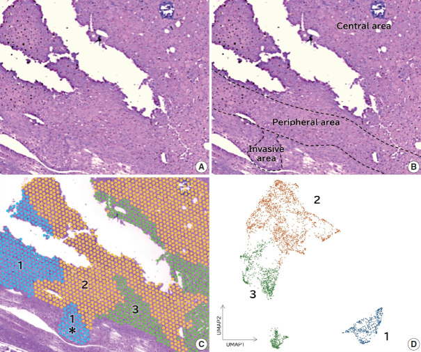 Identification of invasive subpopulations using spatial transcriptome analysis in thyroid follicular tumors.