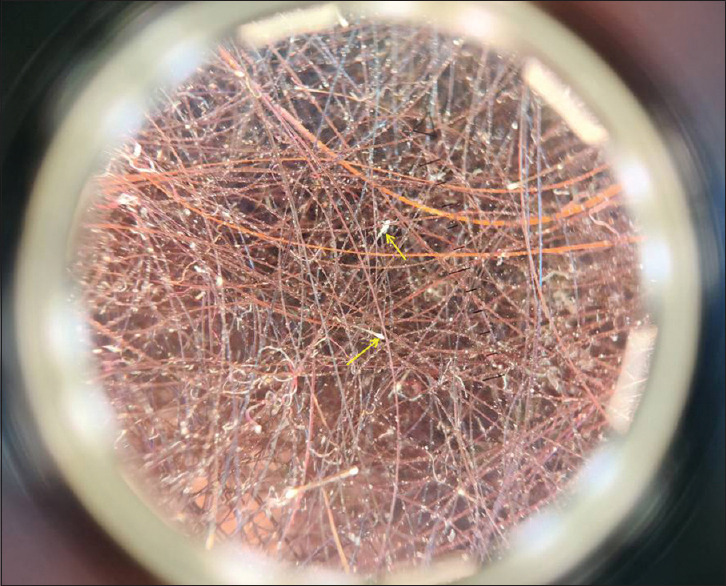Hair Root Dermoscopy from Shed Hair: A Simple Diagnostic Tool in Telogen Effluvium.