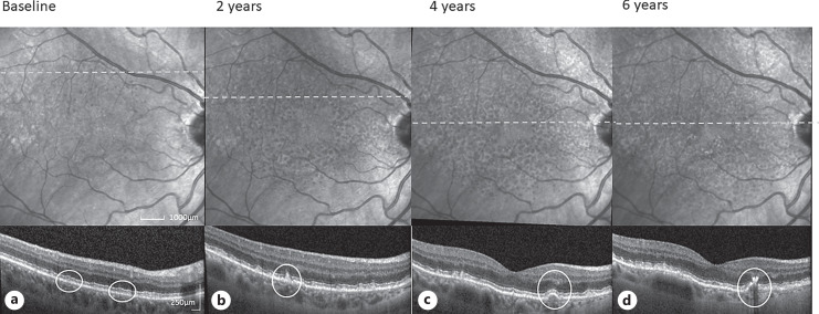 Current Perspectives on Type 3 Macular Neovascularization due to Age-Related Macular Degeneration.