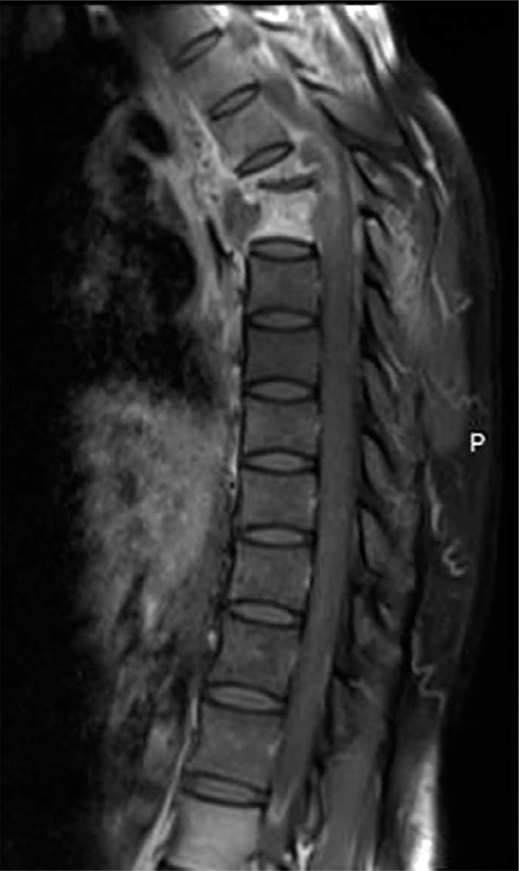 Non-traumatic spinal cord injury - etiological profile and associated factors: single rheumatological center experience.