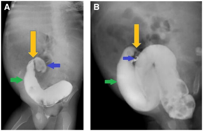 Delayed presentation of congenital sigmoid colon stenosis: a rare entity.