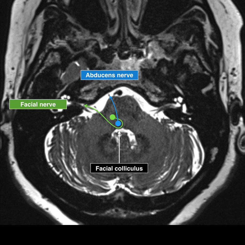 Treatment Challenges in Hemifacial Spasm: The Role of Magnetic Resonance Imaging.