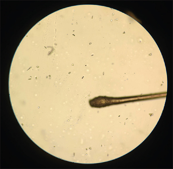 Hair Root Dermoscopy from Shed Hair: A Simple Diagnostic Tool in Telogen Effluvium.