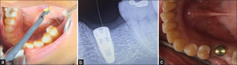 A novel technique to detect cover screw location at stage two uncovery surgery over conventional technique - A randomized controlled trial.