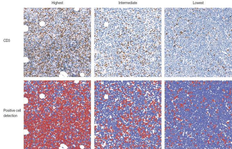 Tumor-infiltrating T lymphocytes evaluated using digital image analysis predict the prognosis of patients with diffuse large B-cell lymphoma.