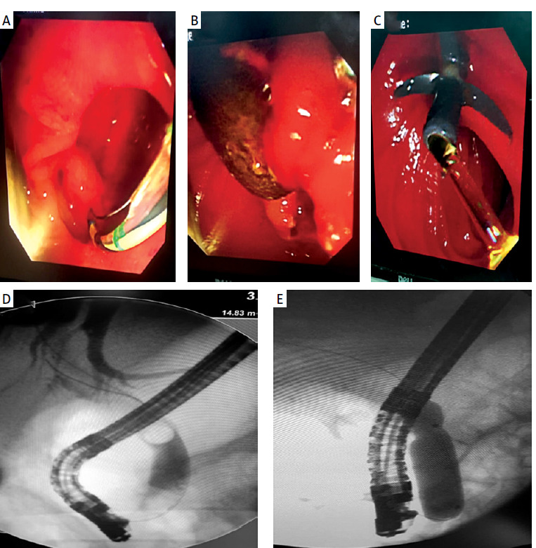Impact of periampullary diverticulum on endoscopic retrograde cholangiopancreatography: bridging the gap between fiction and reality.