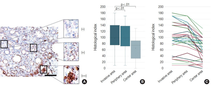 Identification of invasive subpopulations using spatial transcriptome analysis in thyroid follicular tumors.