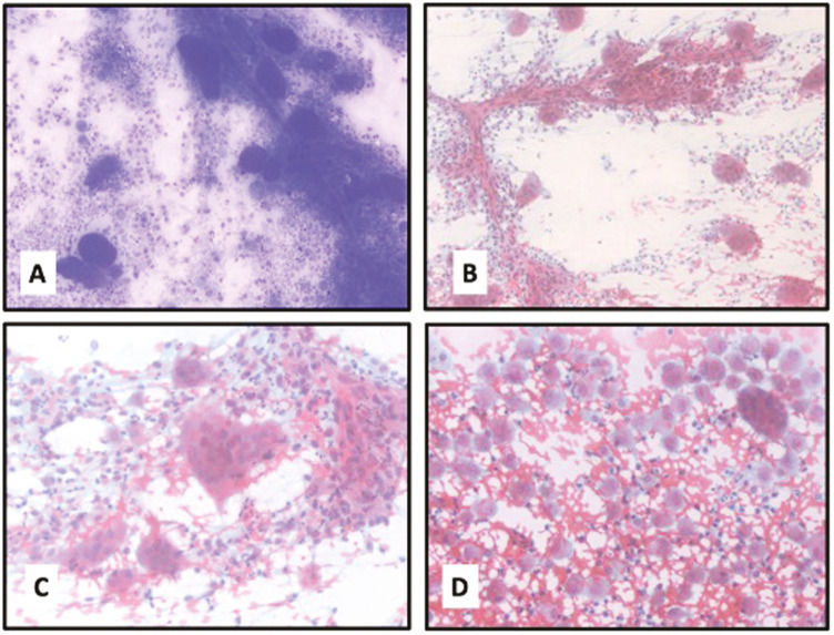 FNAC Diagnosis Giant Cell Reparative Granuloma of the Orbit Masquerading as Malignancy.