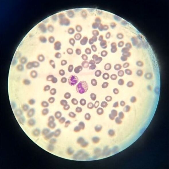 The influence of sepsis on erythrocytes morphology: case report and literature review.