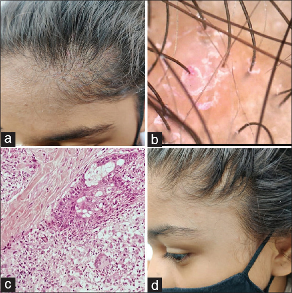 Traction Folliculitis: An Unrecognized Entity.