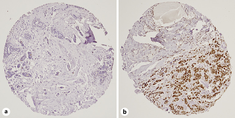 ATF4 as a Prognostic Marker and Modulator of Glutamine Metabolism in Oestrogen Receptor-Positive Breast Cancer.