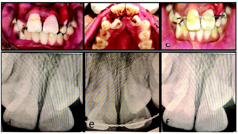 Management of Laryngoscope-Induced Iatrogenic Dental Injury: A Case Series.