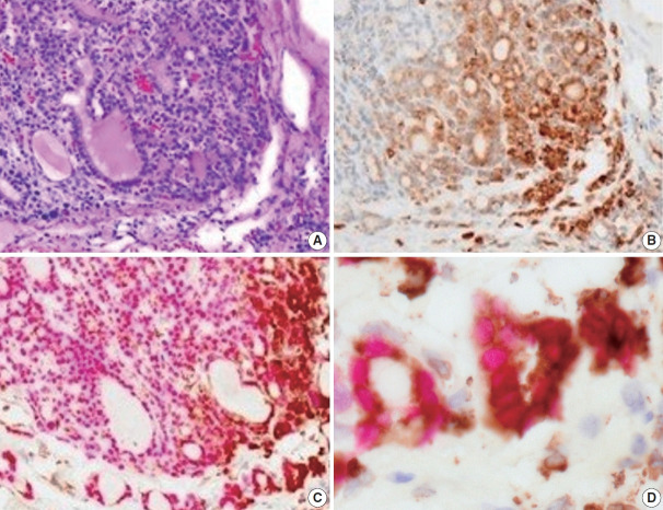 Identification of invasive subpopulations using spatial transcriptome analysis in thyroid follicular tumors.