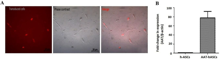 Effectiveness of human adipose tissue-derived mesenchymal stem cells expressing alpha-1 antitrypsin gene in liver fibrosis: a study in mice.