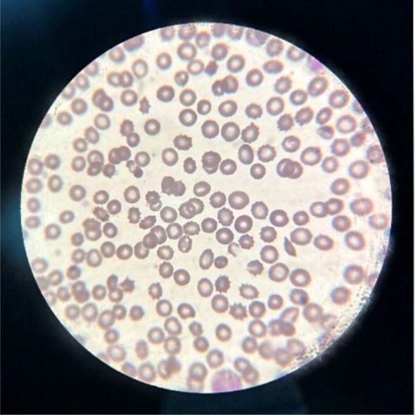 The influence of sepsis on erythrocytes morphology: case report and literature review.