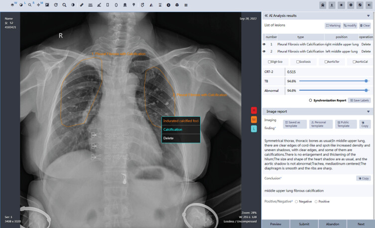 Can AI generate diagnostic reports for radiologist approval on CXR images? A multi-reader and multi-case observer performance study.