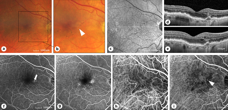 Current Perspectives on Type 3 Macular Neovascularization due to Age-Related Macular Degeneration.