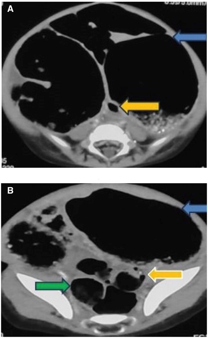 Delayed presentation of congenital sigmoid colon stenosis: a rare entity.