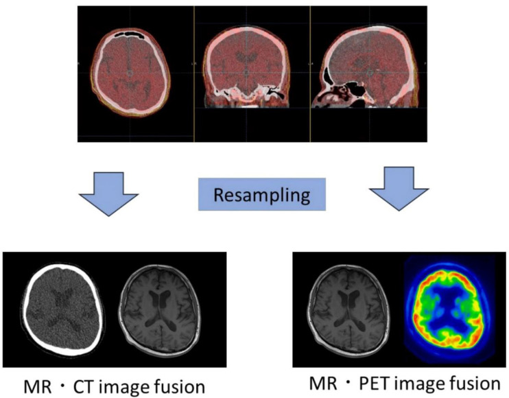 Feasibility of direct brain <sup>18</sup>F-fluorodeoxyglucose-positron emission tomography attenuation and high-resolution correction methods using deep learning.