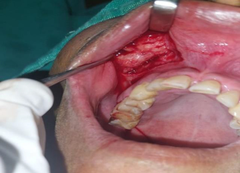 Beyond the Usual Suspects: Primary Premaxilla Sarcoidosis.