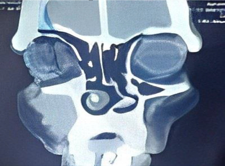 Beyond the Usual Suspects: Primary Premaxilla Sarcoidosis.