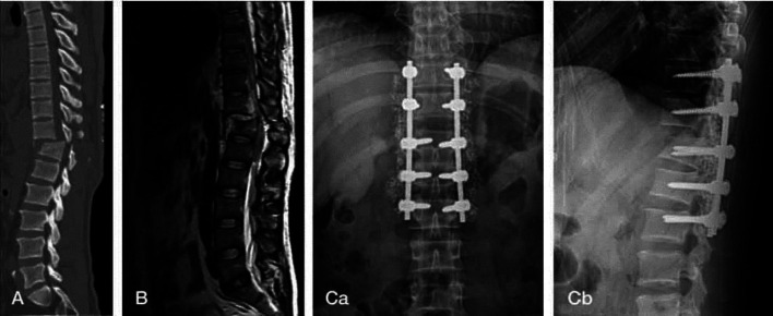 Recent Advances in the Treatment of Spinal Cord Injury.