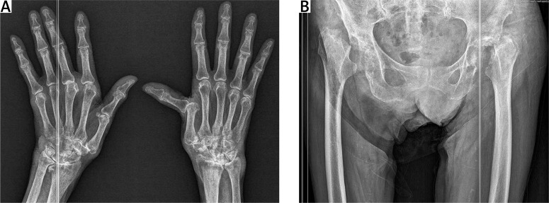 Bilateral rapidly destructive coxopathy in rheumatoid arthritis.