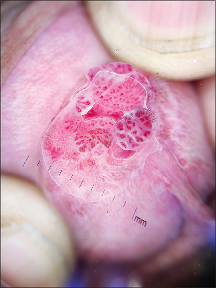 Intra-meatal urethral warts: Clinical and dermatoscopic perspectives.