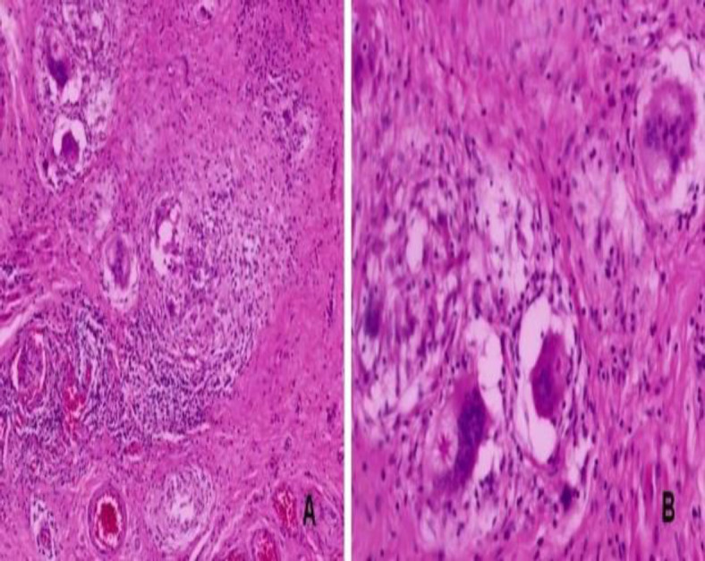 Beyond the Usual Suspects: Primary Premaxilla Sarcoidosis.