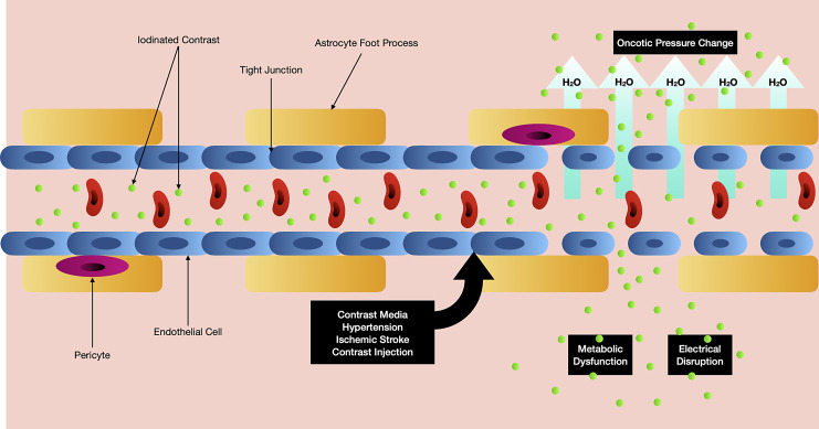 Pathophysiology of Contrast-Induced Neurotoxicity: A Narrative Review of Possible Mechanisms.
