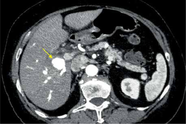 Intrahepatic aneurysm in a branch of the right hepatic artery in a patient with vasculitis due to systemic lupus erythematosus.